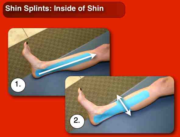 kinesio tape shin splints