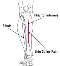 what is a shin splint